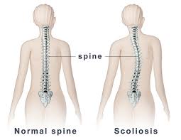 Rối loạn cong cột sống - Hình ảnh minh họa